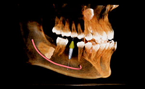 CASO IMPLANTE EN 4 6 CONDUCTO-MANDIBULAR 4 8 MESIOIMPACTADA