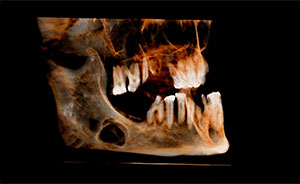 CASO LESION EN C IV